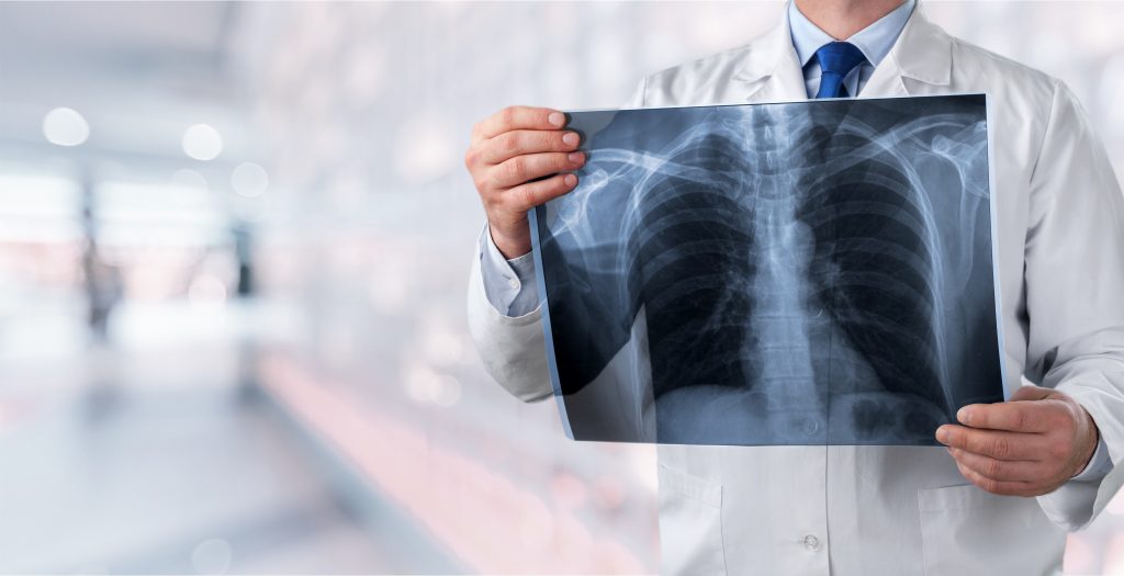 Four Common Types of Occupational Disease Lung Claims Compensable in North Carolina
